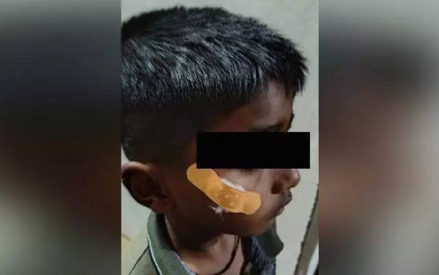 തുന്നലിടുന്നതിന് പകരം മുറിവിൽ പശവെച്ച് ഒട്ടിച്ചു; കർണാടകയിൽ നഴ്സിനെ സസ്പെൻ്റ് ചെയ്തു